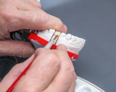 Prothèses, implants… que faire avec un devis dentaire ?