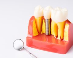 Mutuelle santé : le remboursement des implants dentaires