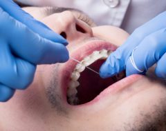 Mutuelle santé : comment est remboursée l’orthodontie pour adulte ?