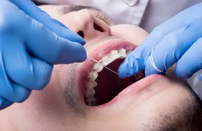 Surcomplémentaire orthodontie adulte : à quoi sert-elle et quel remboursement propose-t-elle ?