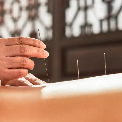 La mutuelle rembourse-t-elle l&#039;acupuncteur ?