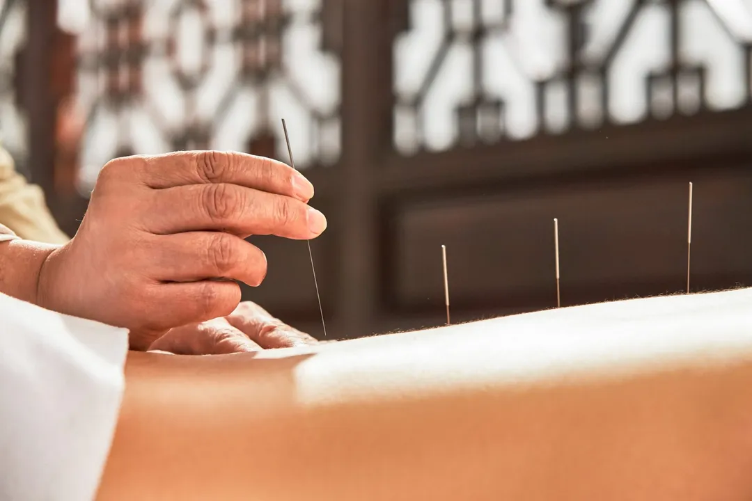 La mutuelle rembourse-t-elle l'acupuncteur ?