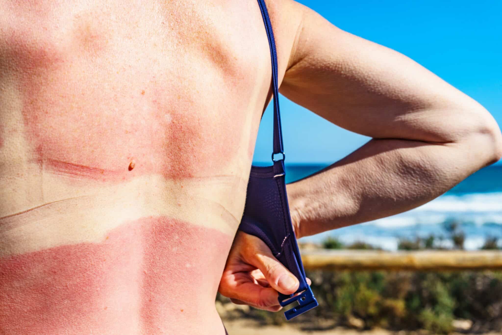 coup de soleil sur un corps de femme