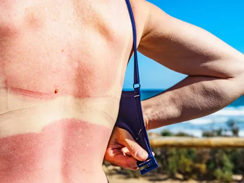 Mutuelle santé : qui consulter en cas de gros coup de soleil ?